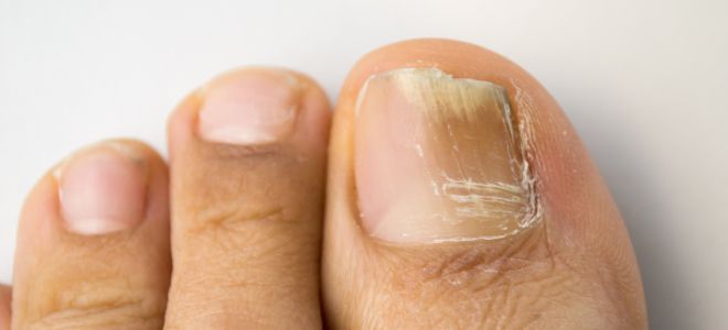 Hogyan lehet kezelni a gombás fertőzést a lábán ⋆ Körömgomba kezelése