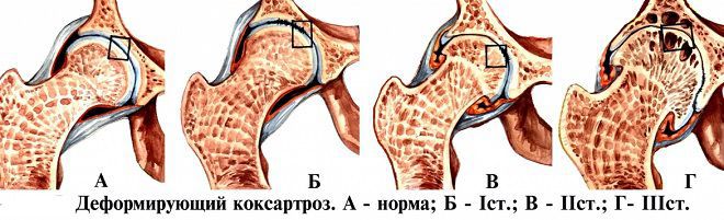 prvi stupanj liječenja osteoartritisa)