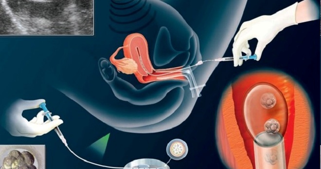 Prosedur IVF IVF IVF secara berperingkat. Berapa banyak embrio 